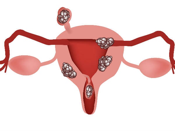  ఫైబ్రాయిడ్లను ప్రభావితం చేసే గర్భం.