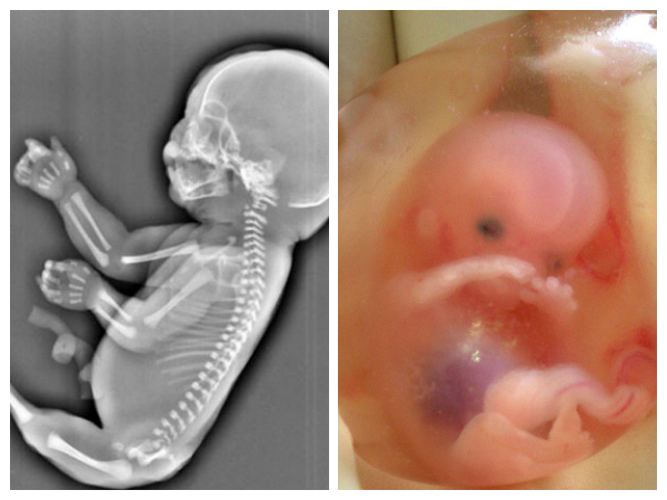 జంటల రక్త రకాలు ఐసోఇమ్యునైజేషన్‌కు దారితీస్తాయి