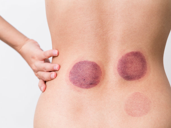 కప్పింగ్ తో మరిన్ని ప్రయోజనాలు