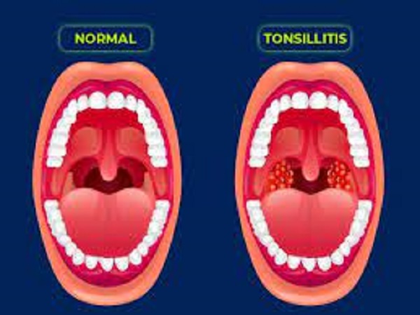 టాన్సిల్ అంటే ?