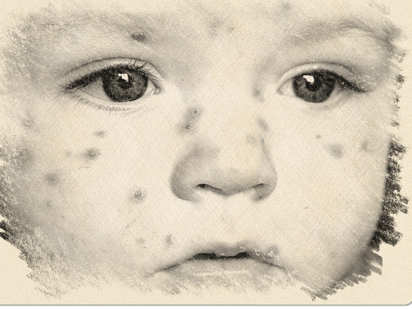 రుబెల్లా లక్షణాలు: