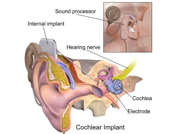 Kerala girl rizwana appears on who world hearing day poster know the details in Telugu