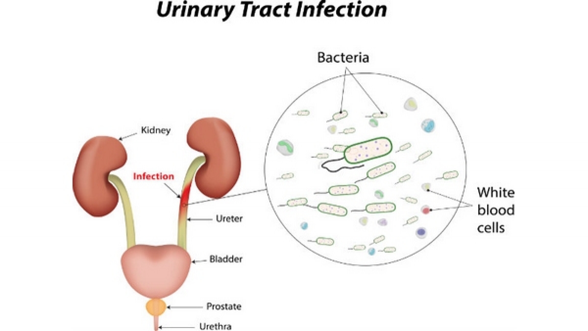 UTI in Men పురుషుల్లో మూత్రనాళ ఇన్ఫెక్షన్ లక్షణాలు, కారణాలు మరియు