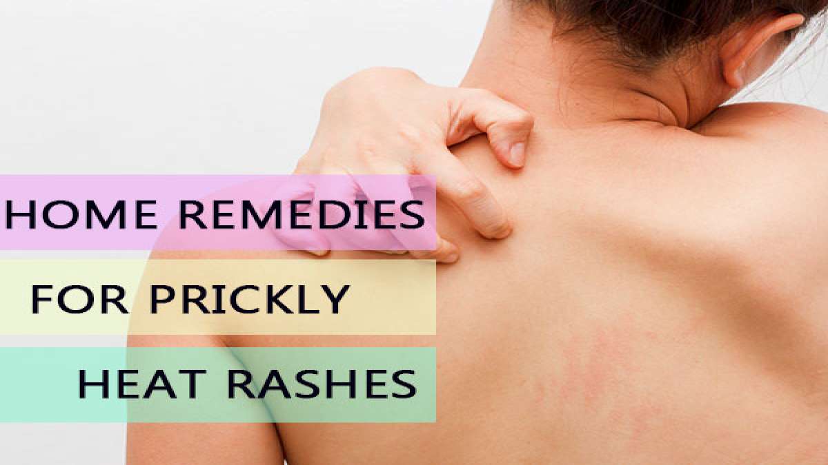 Home Remedies To Treat Sweat Rash Or Prickly Heat in Summer in telugu