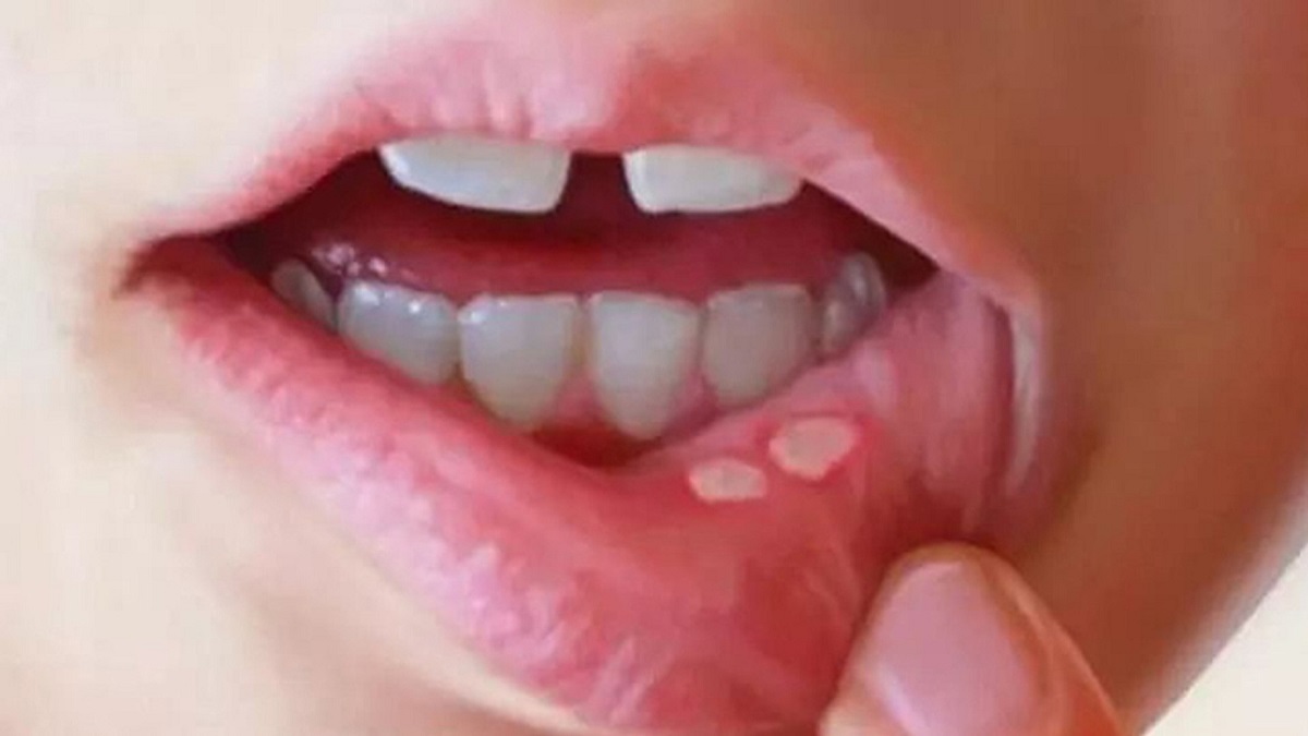 Natural remedies to reduce mouth ulcers in summer in telugu Natural remedies to reduce mouth ulcers in summer in telugu