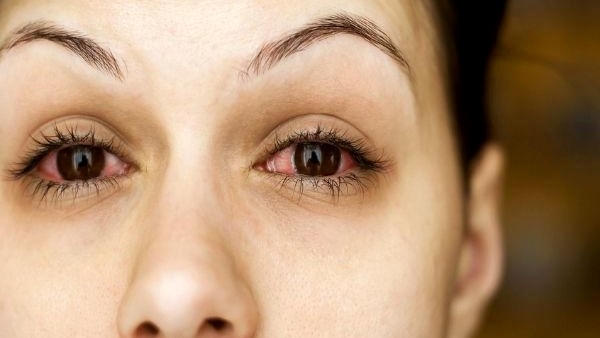  Eye Flu OR Pink Eye: What Are The Myths and Facts About Pink Eye in telugu