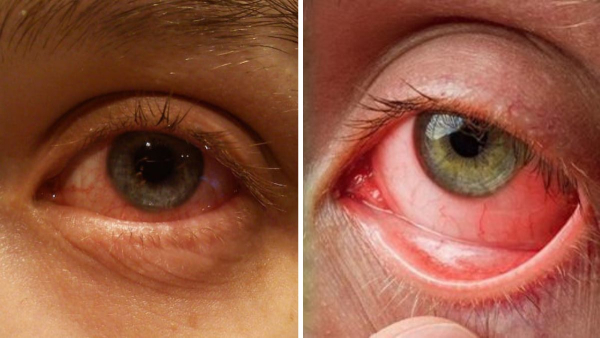 Precautions To Prevent Pink Eye Infection in Monsoon In Telugu