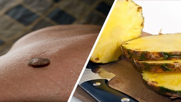 Skin Warts: Effective Home Remedies To Get Rid Of Warts in Telugu