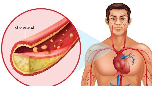 Daily food items that may be causing high cholesterol in Telugu