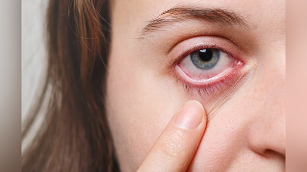 Myth vs Fact : Does Applying Saliva on Eyes Treat Eye Flu, Know What Expert Says