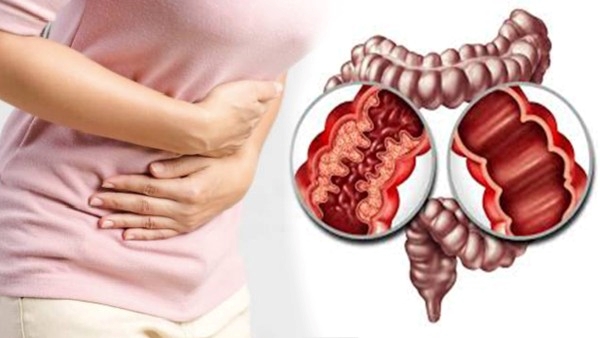 Doctors Find Living Fly in Man Intestines