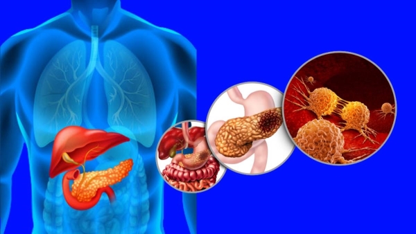 World Pancreatic Cancer Day 2023