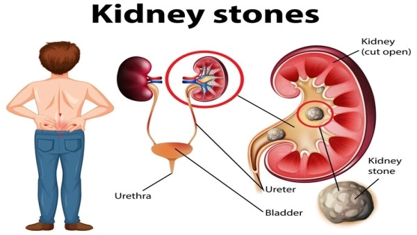 kidney stone kidney stone