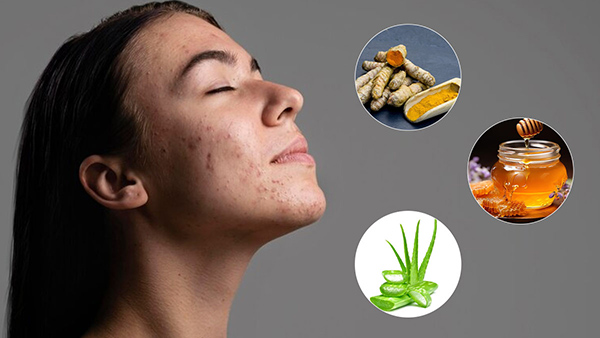 Home Remedies For Chin Pimples In Telugu