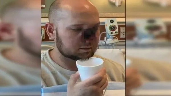 Man Who Lost His Nose Due To Fungal Infection