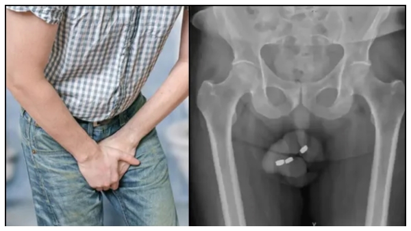  Australia Doctors Remove Batteries From Mans Private Part 