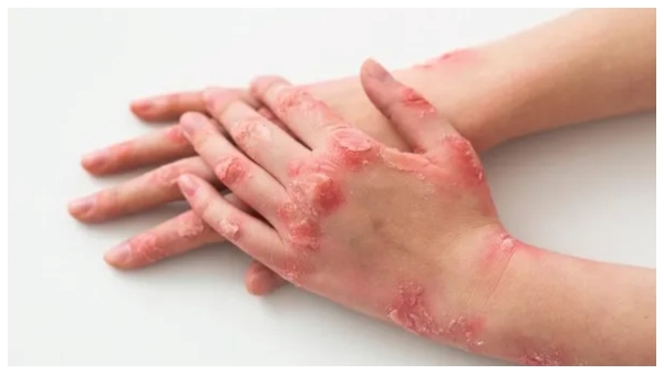  What Is Alaskapox and Symptoms in telugu, First Case Died From Alaskapox