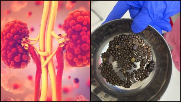 Hyderabad Doctors removed 418 Kidney stones from 60 year old patient