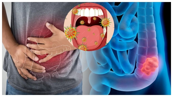 Bacteria in the mouth can cause colon cancer A recent study