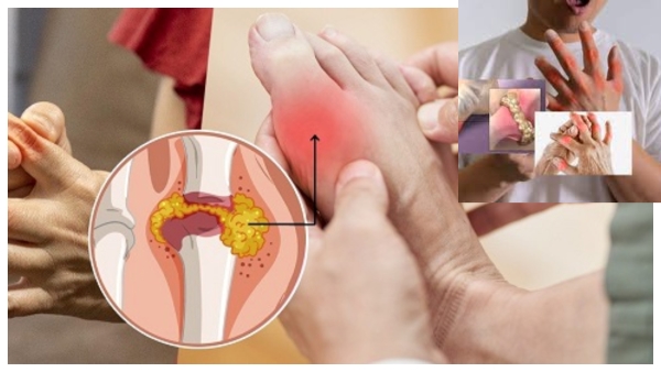 High Uric Acid Symptoms in Men