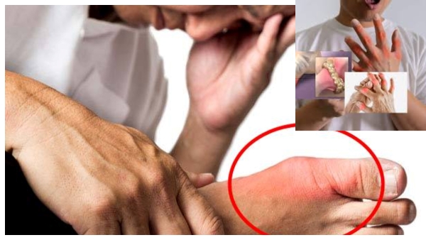 High Uric Acid Symptoms in Men