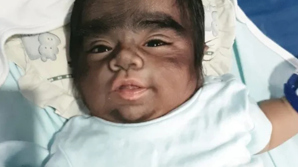Hairiest Baby in the world born suffering from hypertrichosis because mother ate wild cats Hairiest Baby in the world born suffering from hypertrichosis because mother ate wild cats