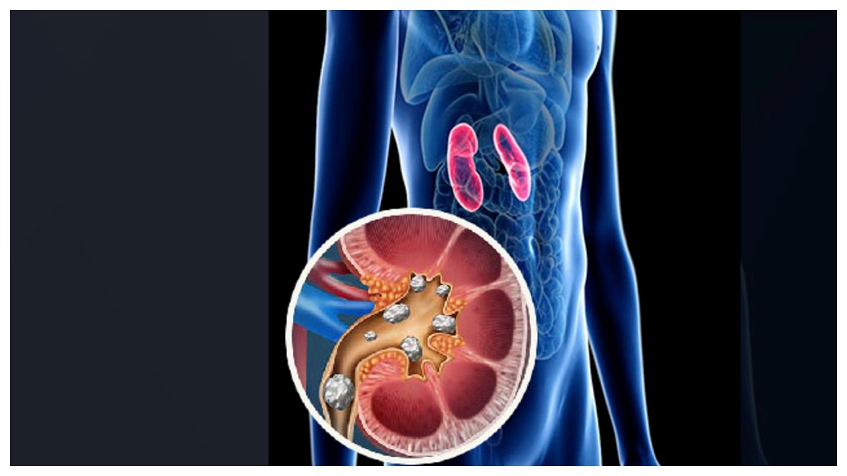 What Are The Early Symptoms of Kidney Stones in telugu What Are The Early Symptoms of Kidney Stones in telugu