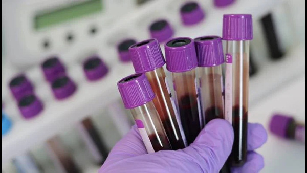 cancer-can-be-detected-before-7-years-with-the-use-of-blood-protein