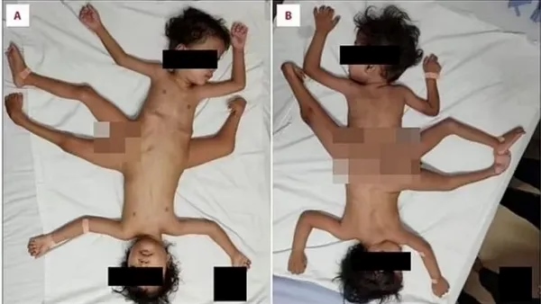 Extremely Rare Conjoined Twins born with three legs and four arms