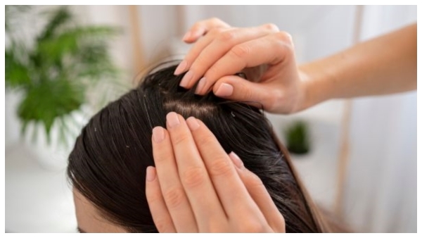 Effective Natural Remedies For Dandruff-Free Hair In Monsoon