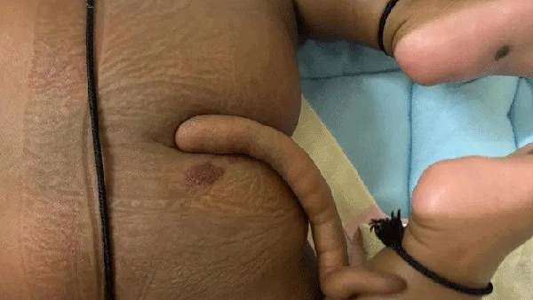 Baby Boy born with tail and Bibinagar Aiims doctors removed