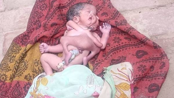 Baby born in Uttarpradesh with 2 heads 4 legs 4 hands