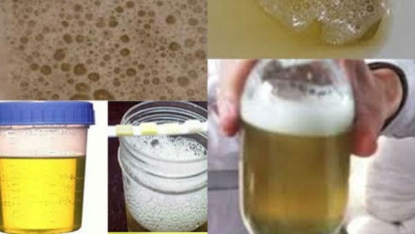 Cloudy Urine in the Morning