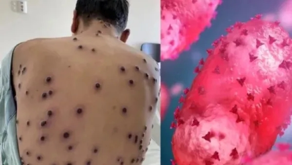 Will monkeypox cause another lockdown