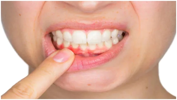 link between gum disease and heart health