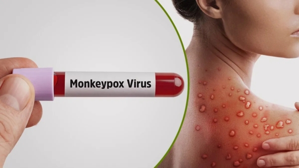Monkeypox First Case Outbreak in India