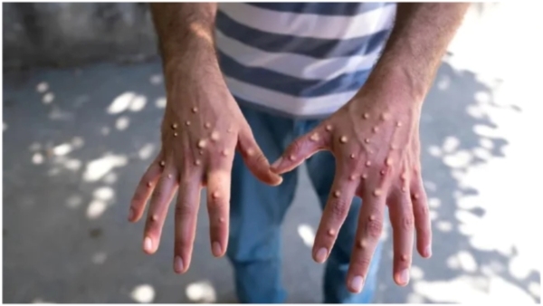 Monkeypox First Case Outbreak in India