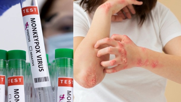 Monkeypox Case Confirmed in Kerala