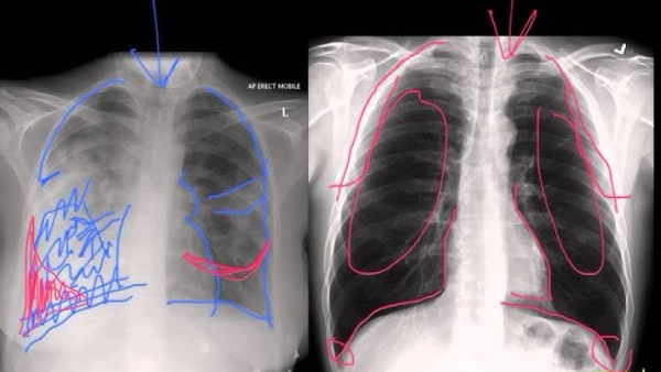 Pneumonia symptoms in childrens and adults Here you need to do Pneumonia symptoms in childrens and adults Here you need to do