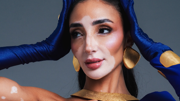 logina salah creates history as first contestant with vitiligo in miss universe 2024 logina salah creates history as first contestant with vitiligo in miss universe 2024