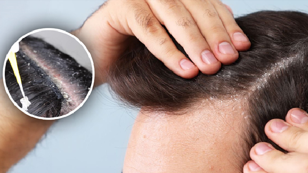 follow this home remedies to check dandruff problem