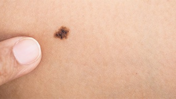 If woman has birthmarks on these places their husbands will become millionaire