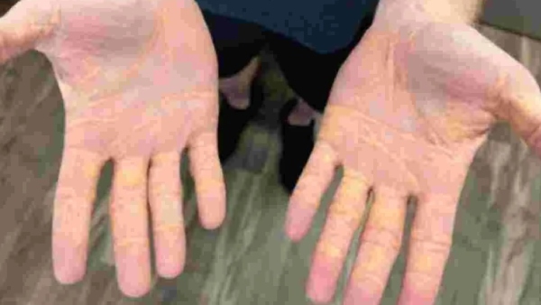 Eating heavy non veg may cause cholesterol leaking problems in human