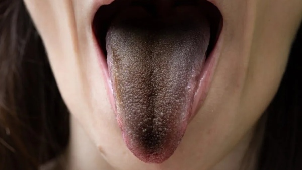 What happens if you have marks on your tongue What happens if you have marks on your tongue