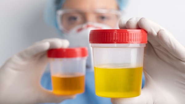 Did you observe your urine color Here is what is your urine colour is saying