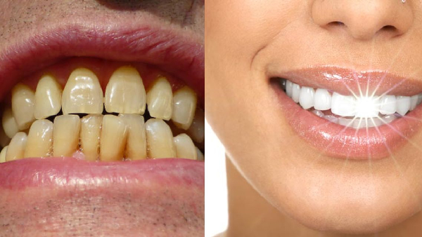 home remedies to whiten yellow teeth without chemicals home remedies to whiten yellow teeth without chemicals