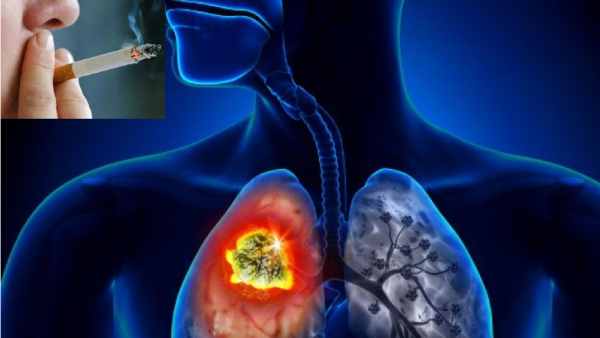 lung cancer rising among non smokers recent study reveals shocking facts