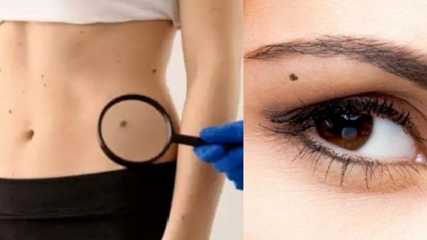 lucky mole spots on body that bring wealth you will become rich if you have a mole there