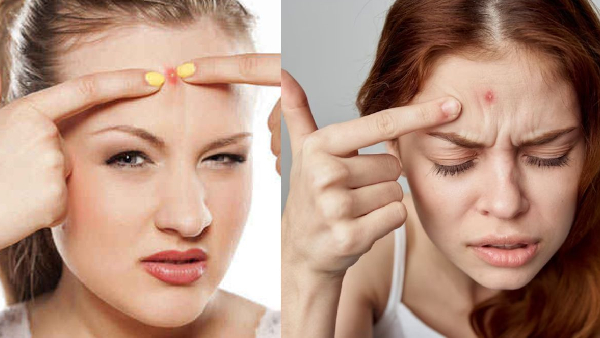 reasons behind pimples on forehead and how to prevent this