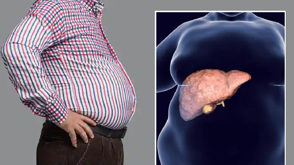 Fatty liver the silent threat increasing mortality by 50 percent Fatty liver the silent threat increasing mortality by 50 percent
